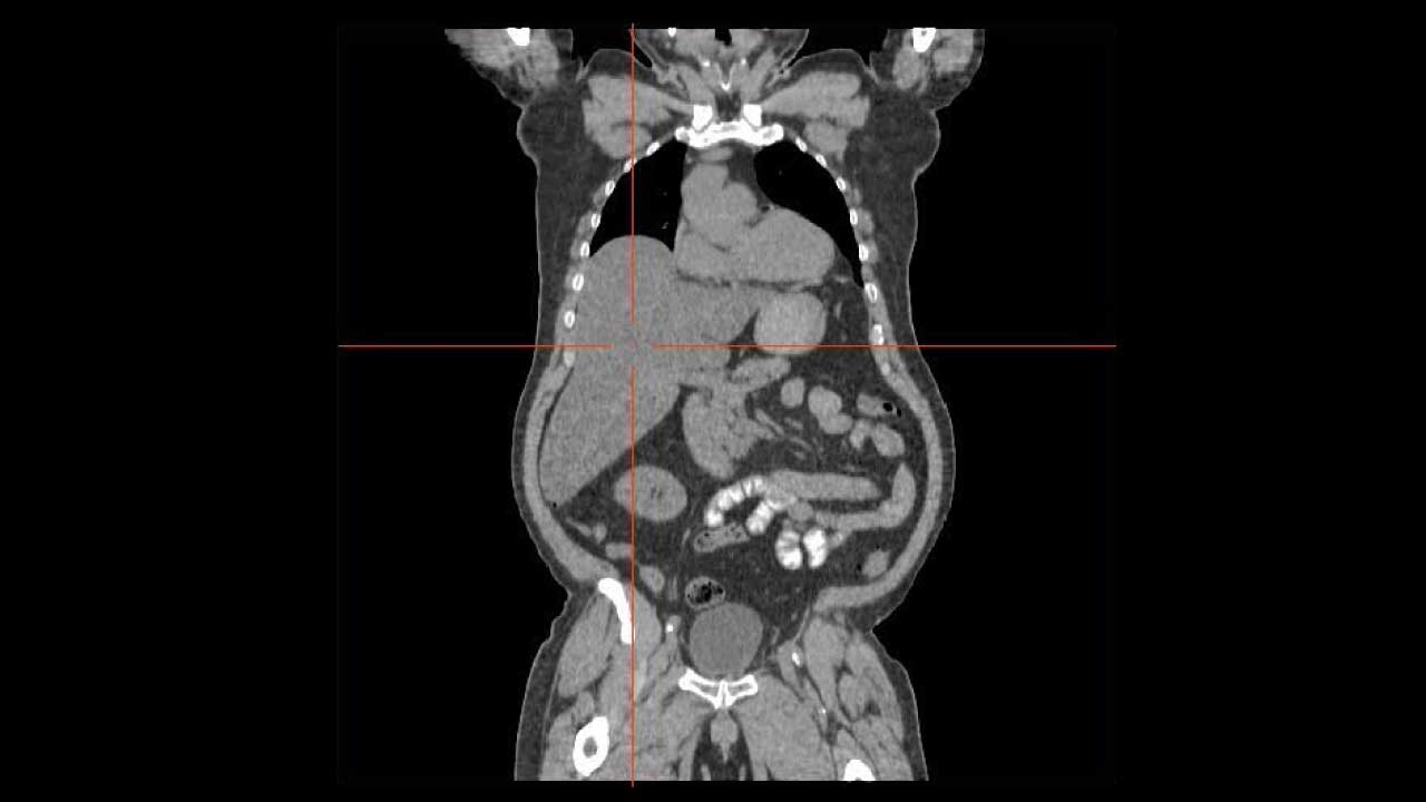 Liver and Causes of Hepatomegaly