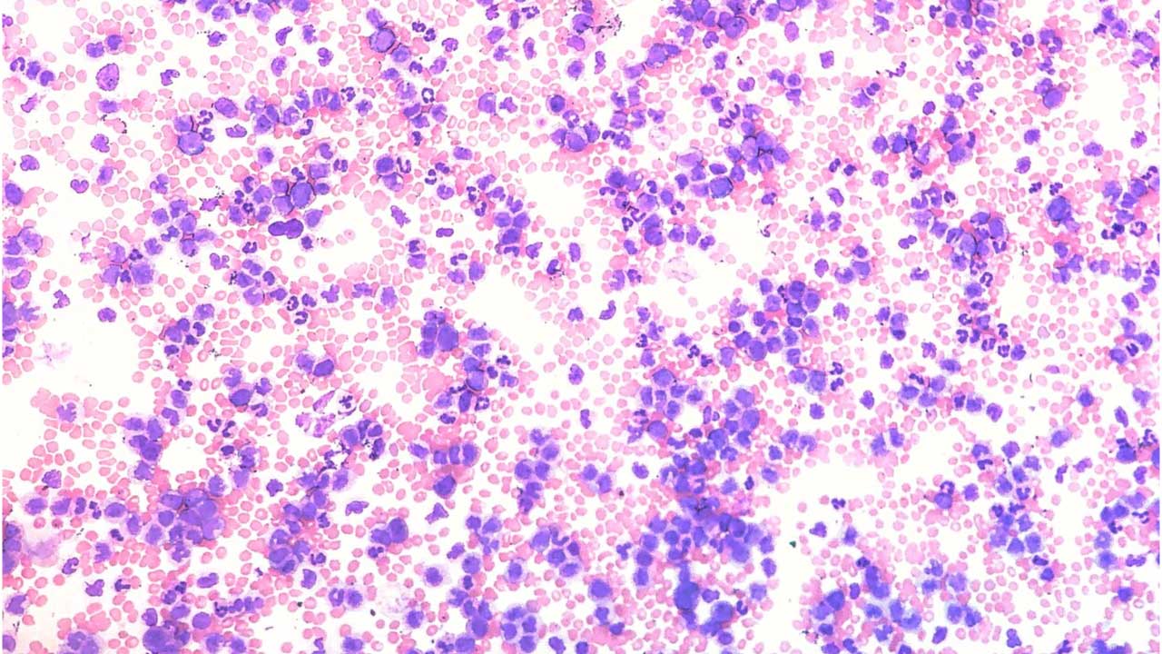 Monocytosis (High Monocytes)
