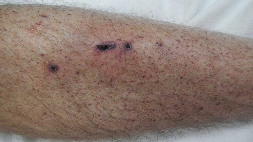Appearance of petechiae in the lower limb due to immune thrombocytopenia.