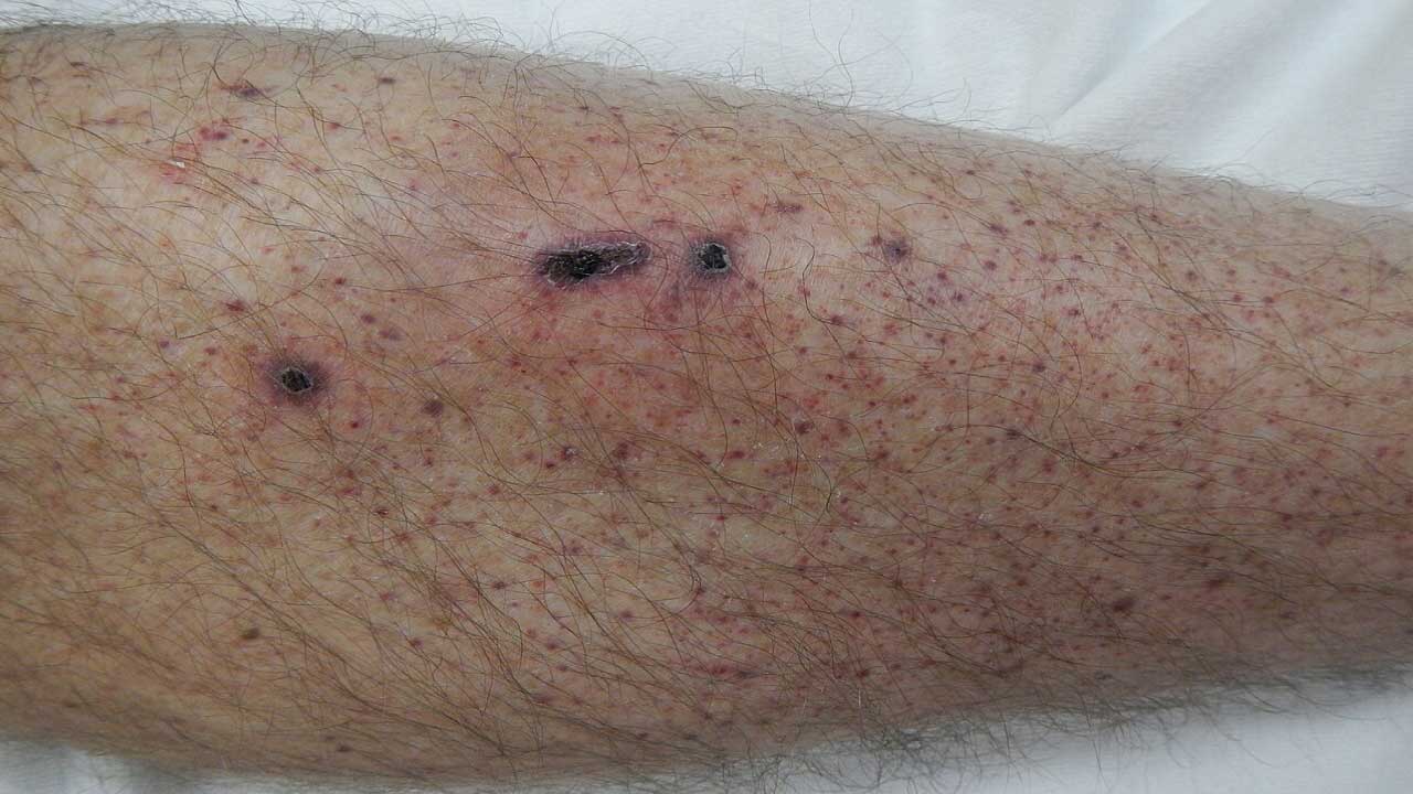 Petechiae