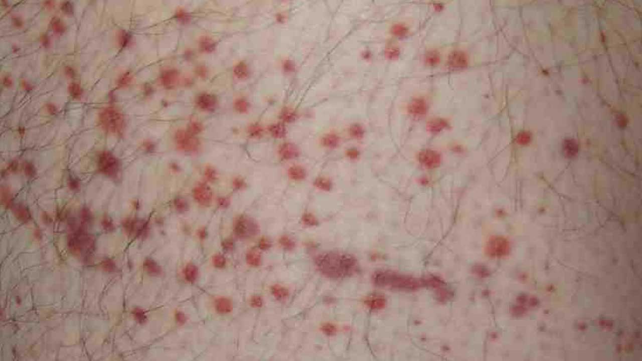 Purpura