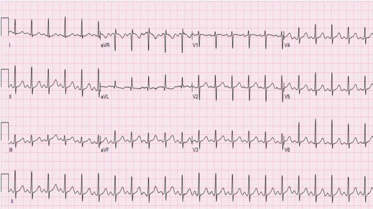 Tachycardia in Hematological Patients