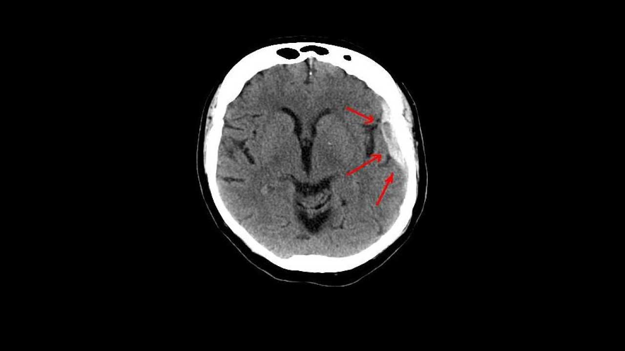 Understanding Hematoma