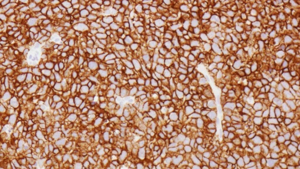 A strong positive CD20 stain confirming diffuse large B-cell lymphoma (DLBCL) in a biopsy sample.