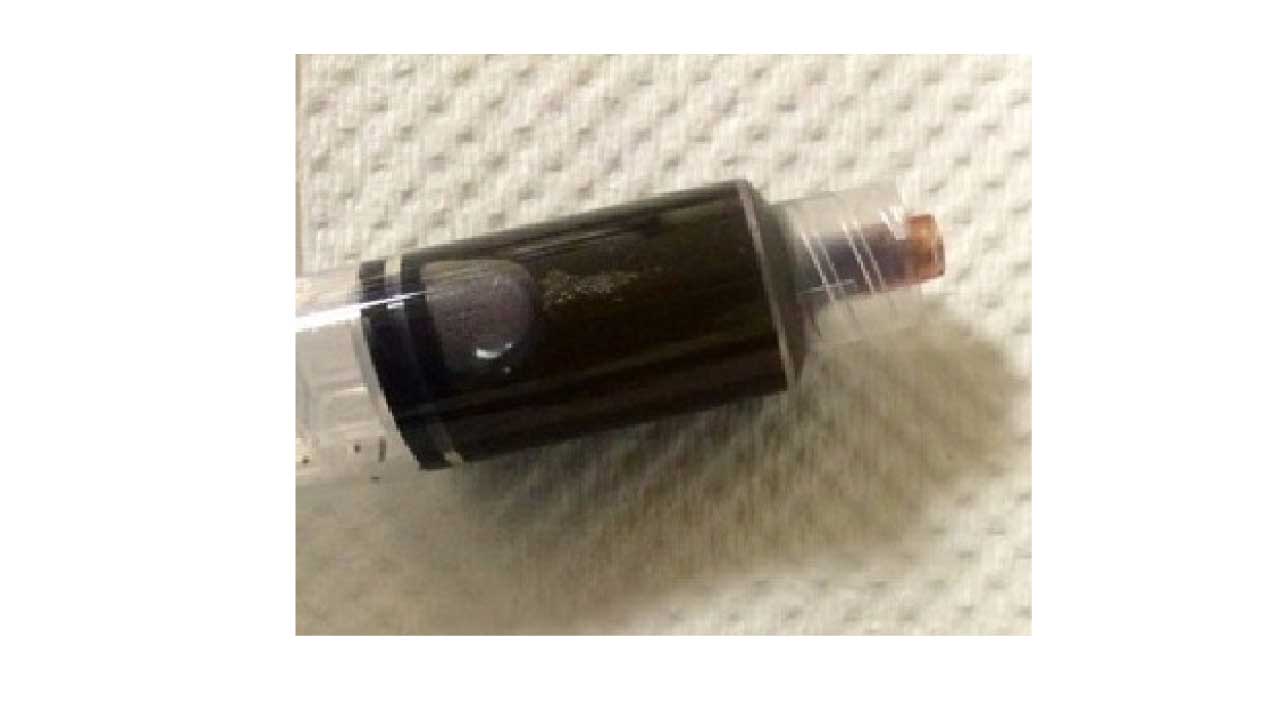 Methemoglobinemia