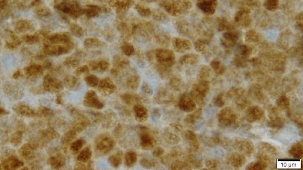 Immunohistochemistry (IHC) staining showed strong nuclear expression of cyclin D1 in the lymphoma cells.