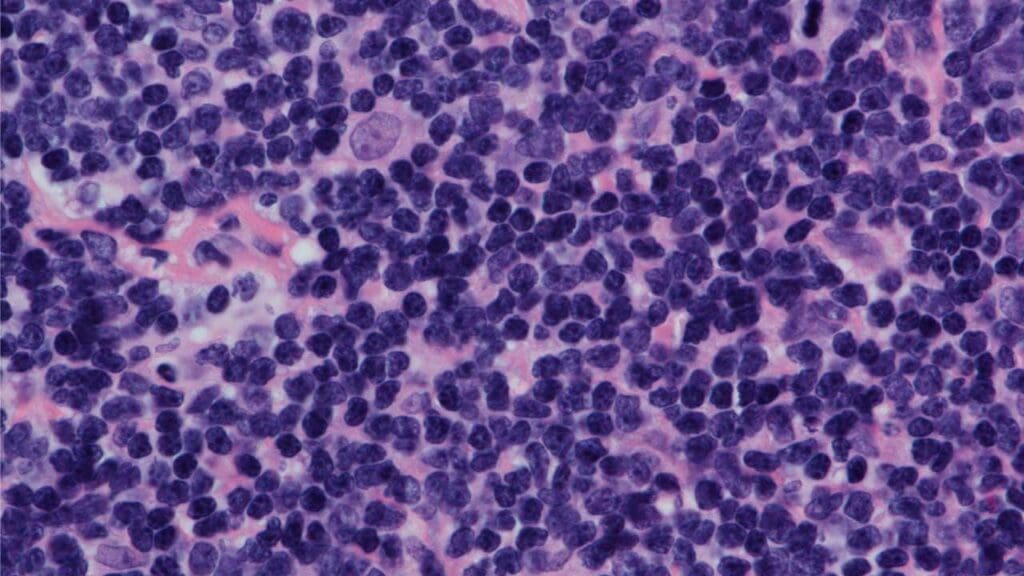 The nodular pattern of Mantle Cell Lymphoma (MCL Disease) is visible at high magnification. The lymphoma cells are of medium size and have irregular nuclear contours. A key feature is the presence of a pink histiocyte interspersed among the malignant cells. Immunohistochemical staining confirmed the diagnosis, as the lymphoma cells were positive for CD5, CD20, and cyclin D1.