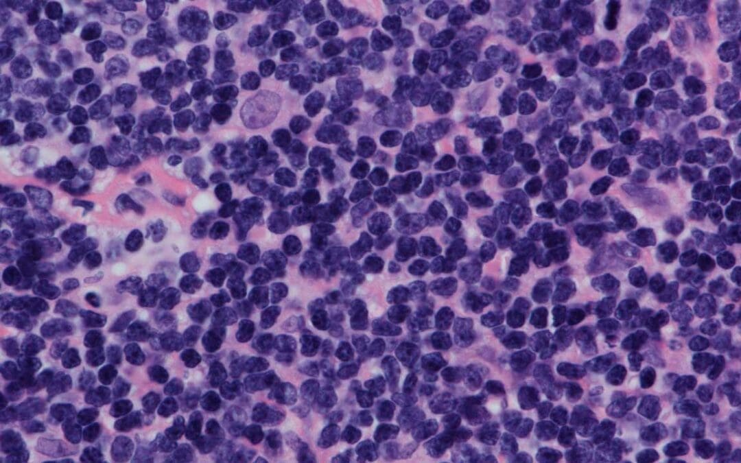 Mantle Cell Lymphoma (MCL Disease)