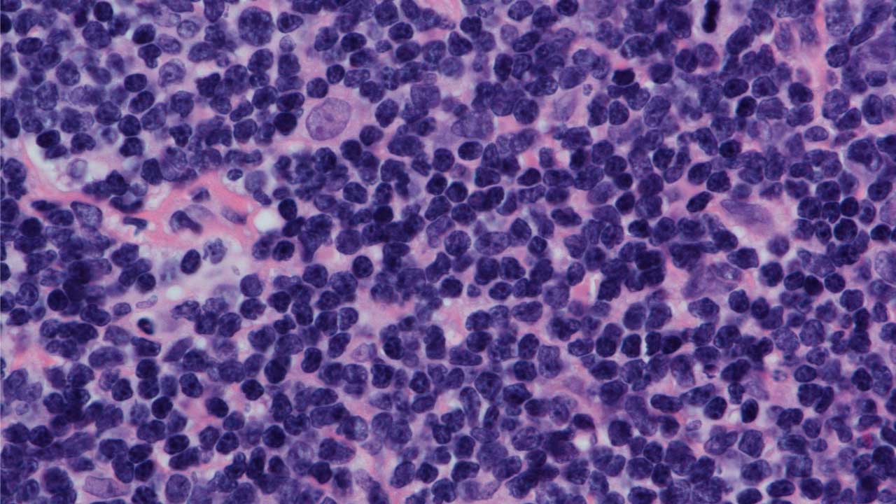 Mantle Cell Lymphoma (MCL Disease)