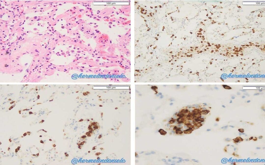 Transfusion-Related Acute Lung Injury or TRALI