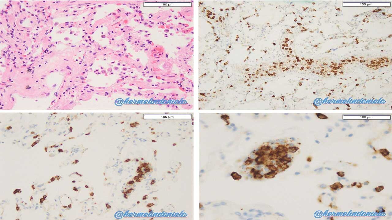Transfusion-Related Acute Lung Injury or TRALI
