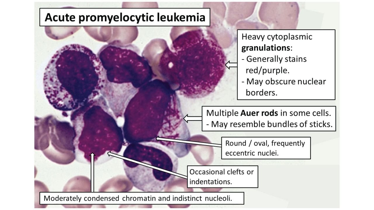Cytology of acute promyelocytic leukemia with PML-RARA