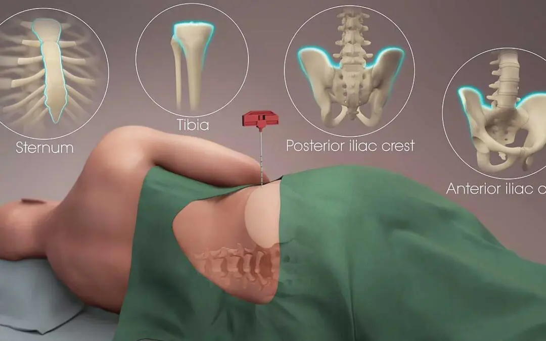 Bone Marrow Aspiration and Trephine Biopsy