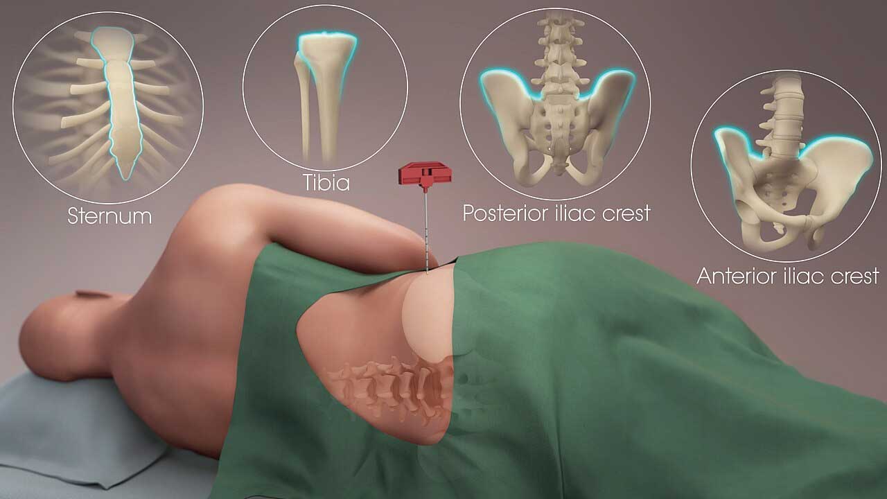 Bone Marrow Aspiration and Trephine Biopsy