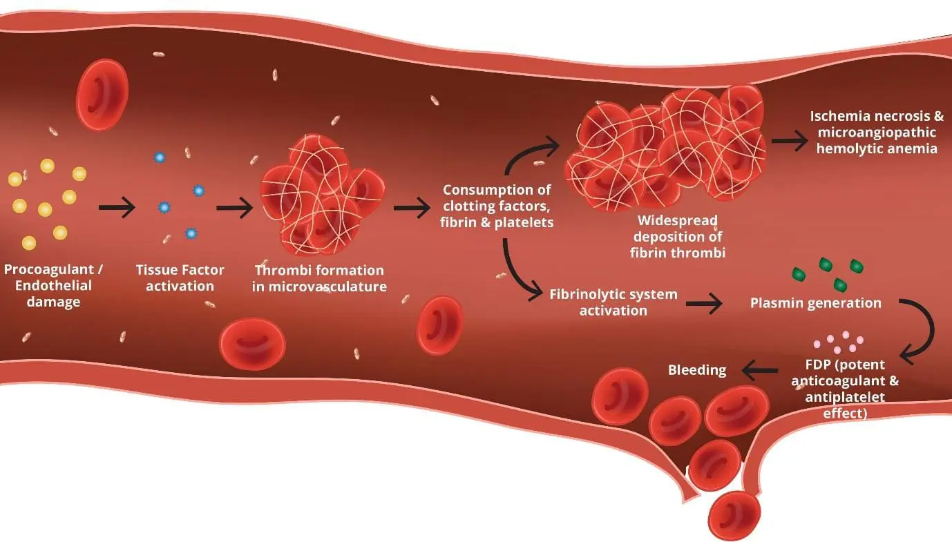 Thrombocytopenia in DIC: A Microscopic Journey through Hemolysis, Thrombosis, and Platelet Consumption