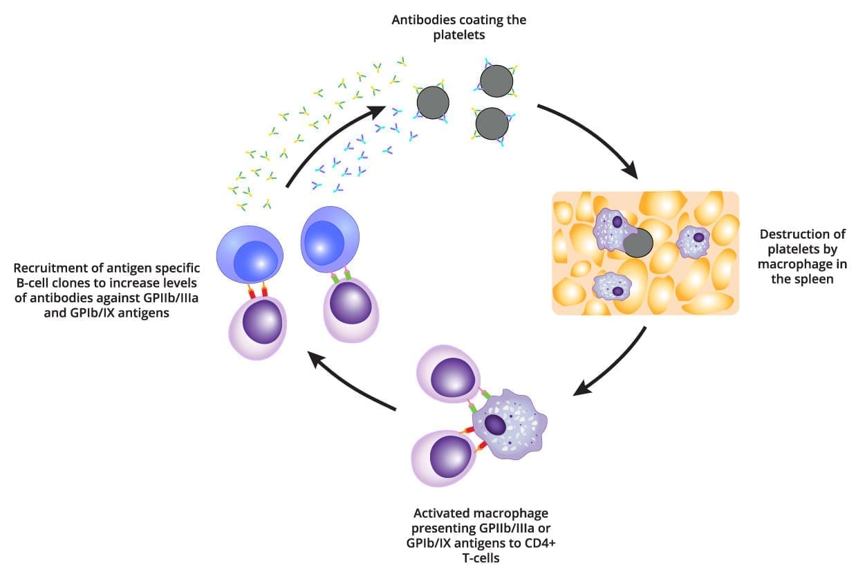A Microscopic View of Platelet Destruction. Image depicting macrophages engulfing platelets coated in antibodies, illustrating the autoimmune-mediated destruction of platelets in primary immune thrombocytopenia (ITP)