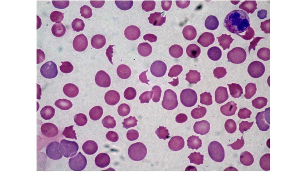 Presence of schistocytes in the peripheral blood smear of DIC (disseminated intravascular coagulation)