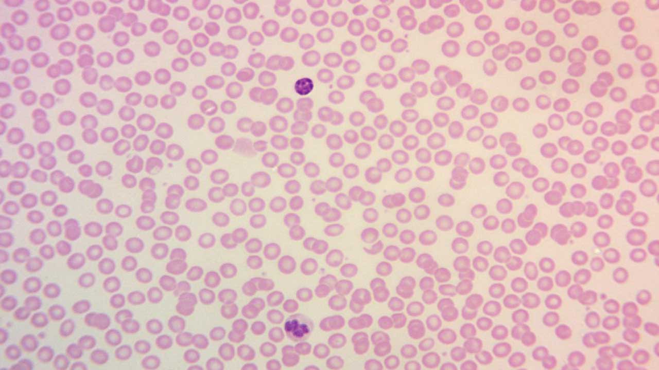 Image depicting a normal peripheral blood smear, highlighting the consistent size and shape of red blood cells with central pallor occupying approximately one-third of their diameter
