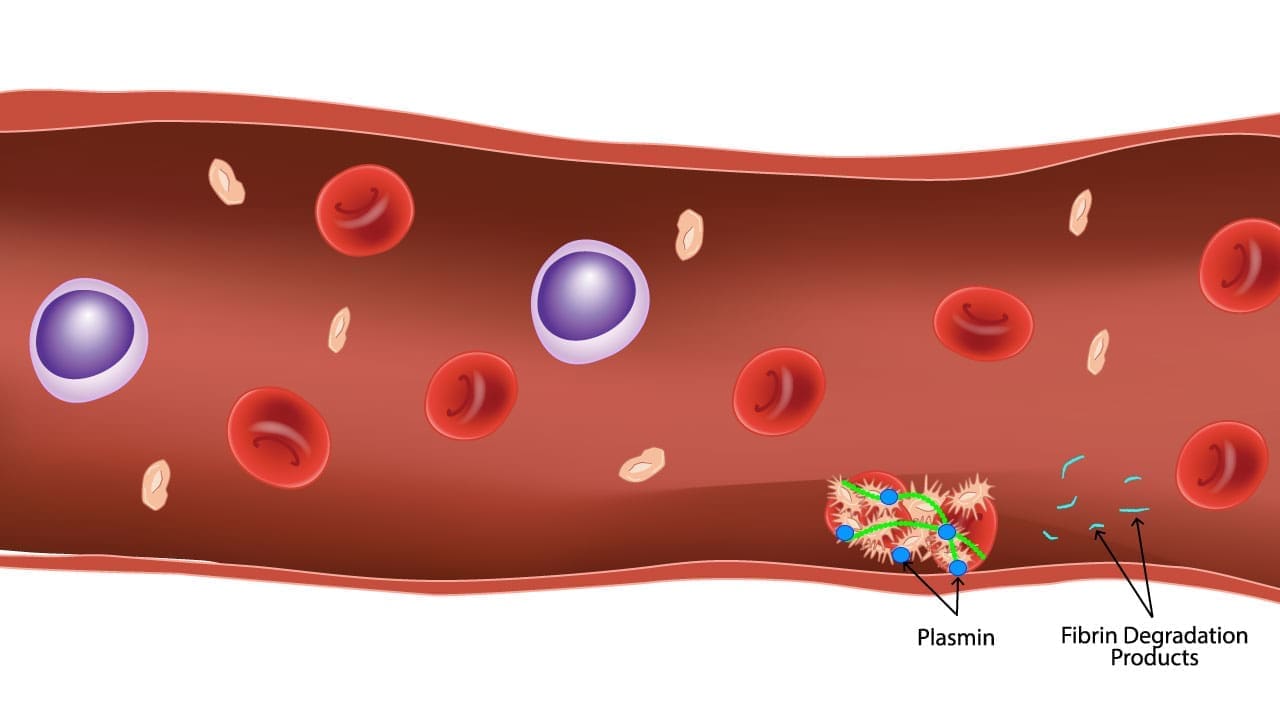 This image captures the dissolution of a blood clot by plasmin, a molecular enzyme. See the fibrin strands, once a protective mesh, breaking down into smaller fragments called fibrin degradation products (FDPs) including D-dimer. This regulated process ensures the clot doesn't outstay its welcome, promoting smooth blood flow and tissue healing.
