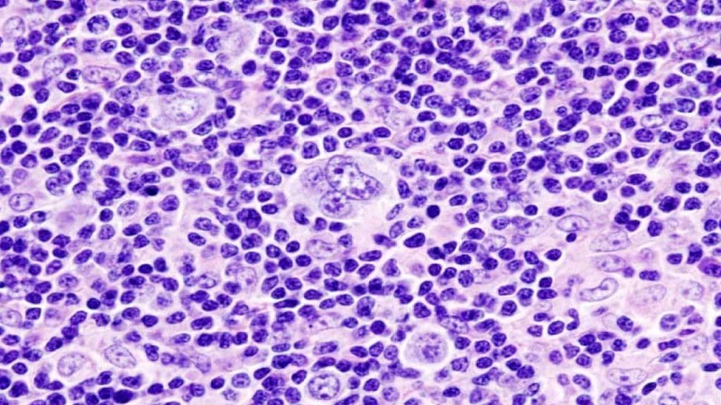 Histopathologic image of mixed cellularity Hodgkin lymphoma or Hodgkin's disease. Lymph node biopsy. H & E stain.