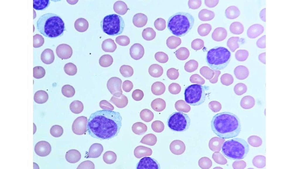 Image depicting a peripheral blood smear showcasing the hallmark findings of CLL white elevated WBCs