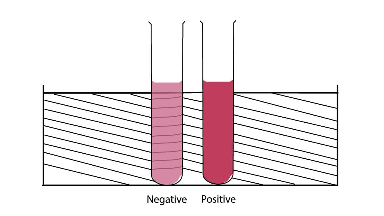 Sickle Cell Disease Test
