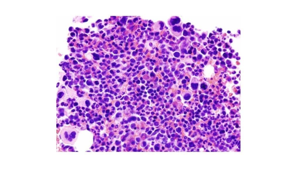 Bone marrow aspirate in essential thrombocythemia