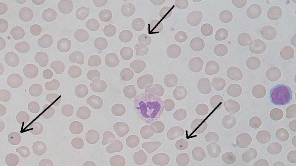 Howell-Jolly inclusion bodies in the red cells pointing to a potential problem in the spleen.