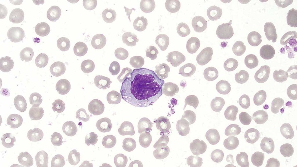 Monocyte in a peripheral blood smear with the characteristic U- or kidney-shaped nucleus. Monocyte is part of the WBCs.