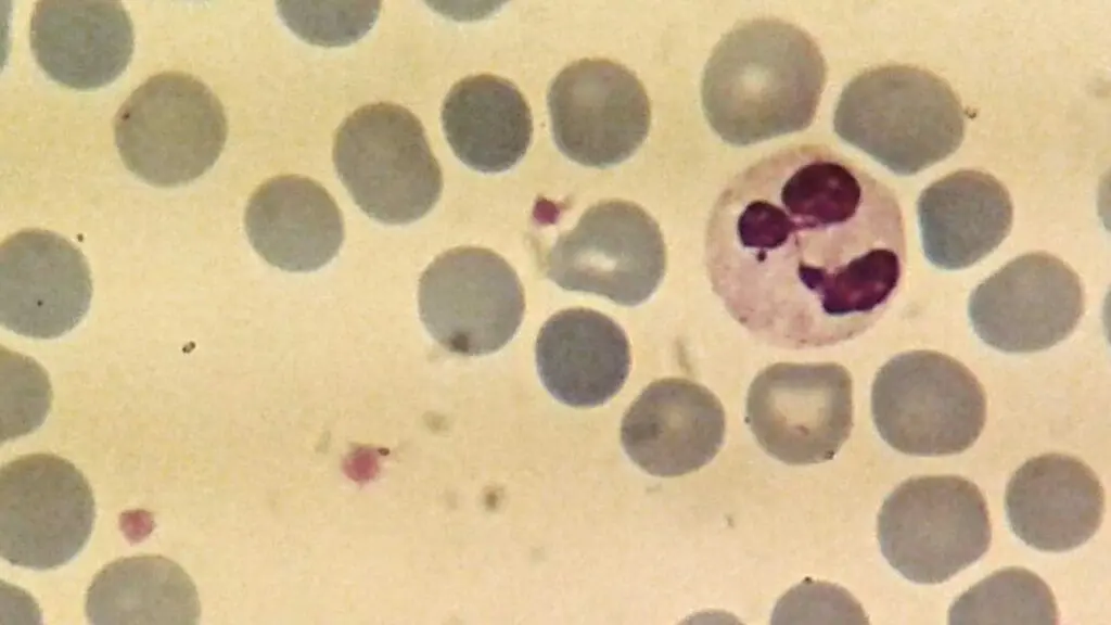 A neutrophil in the peripheral blood smear with 2 - 5 lobed nucleus and pinkish fine granules in the cytoplasm. Neutrophils are the most abundant type of WBCs