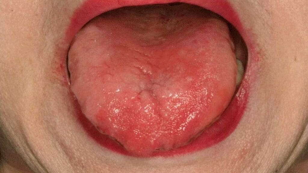 Glossitis can be a  folate deficiency symptom.