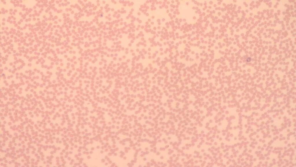Neutropenia can cause leukopenia (low white cell count) as neutrophils are the most abundant white blood cells in our body. 