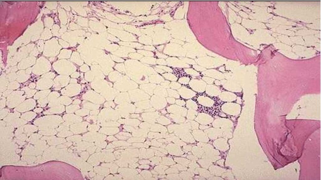 Aplastic anemia leads to lymphopenia (low lymphocytes) and hypocellular bone marrow.