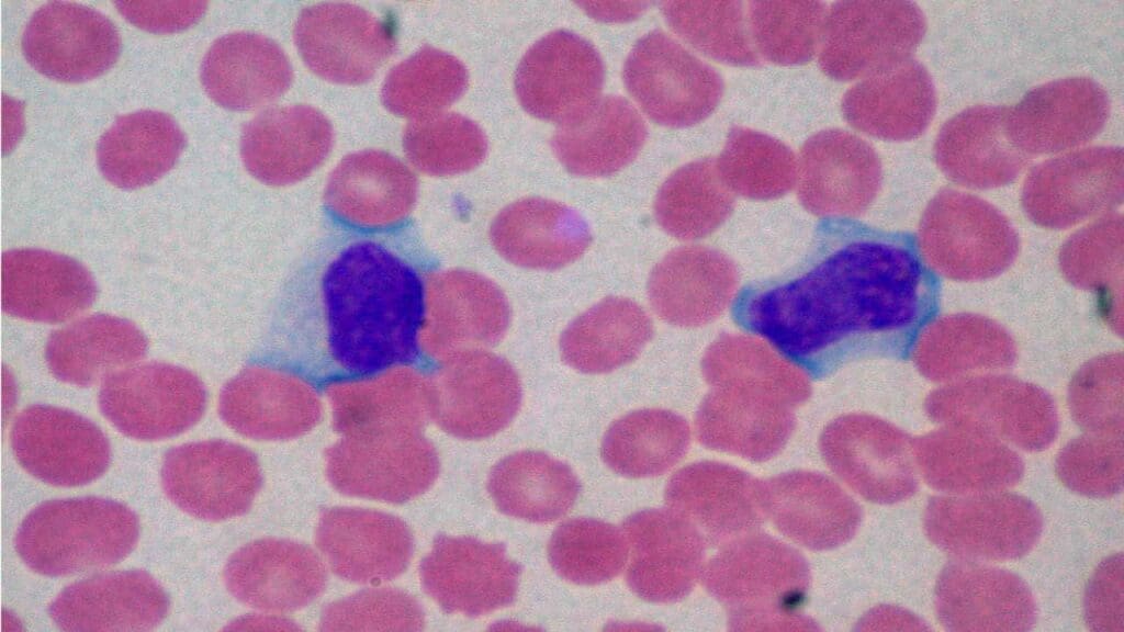 EBV infection can cause reactive lymphocytosis or high lymphocytes. 