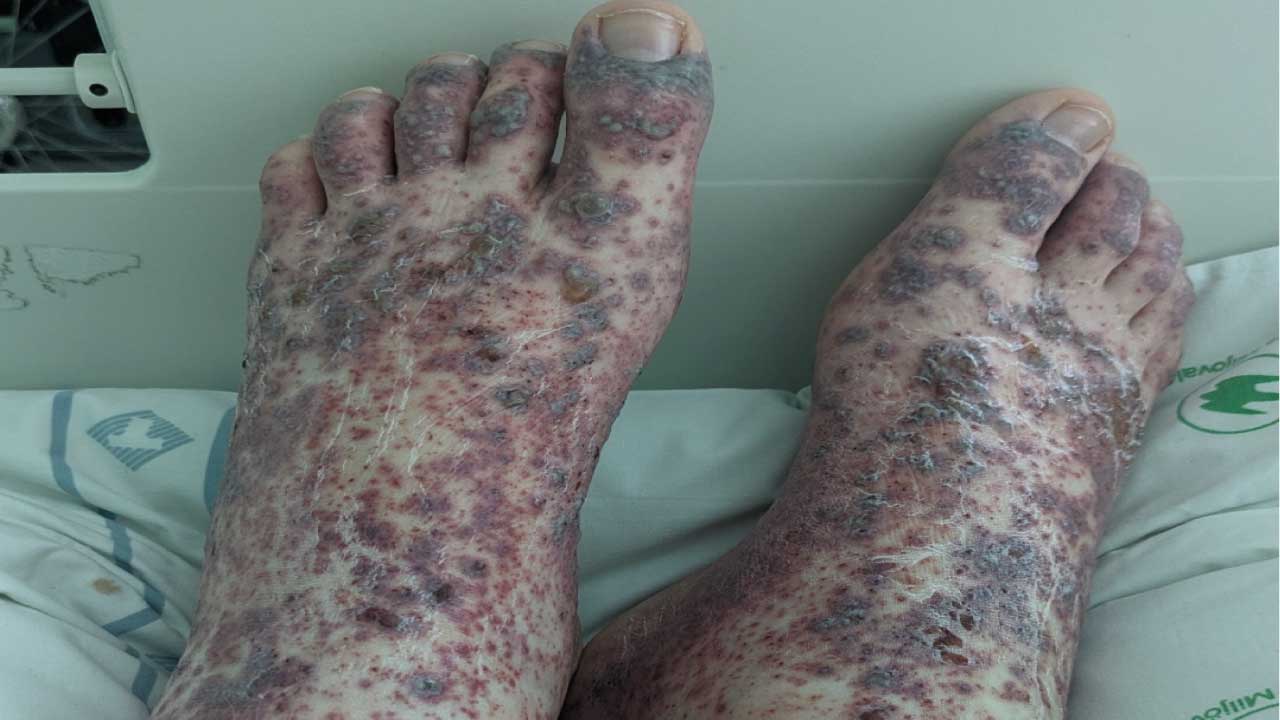 Henoch-Schönlein Purpura (HSP)