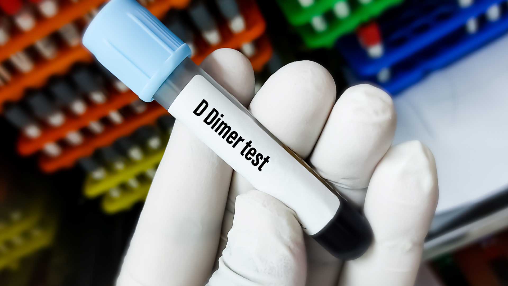 D-Dimer Test