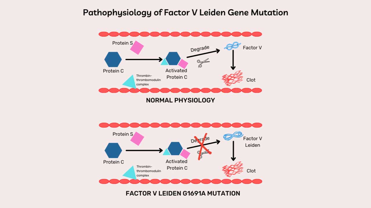 Factor V Leiden Thrombophilia