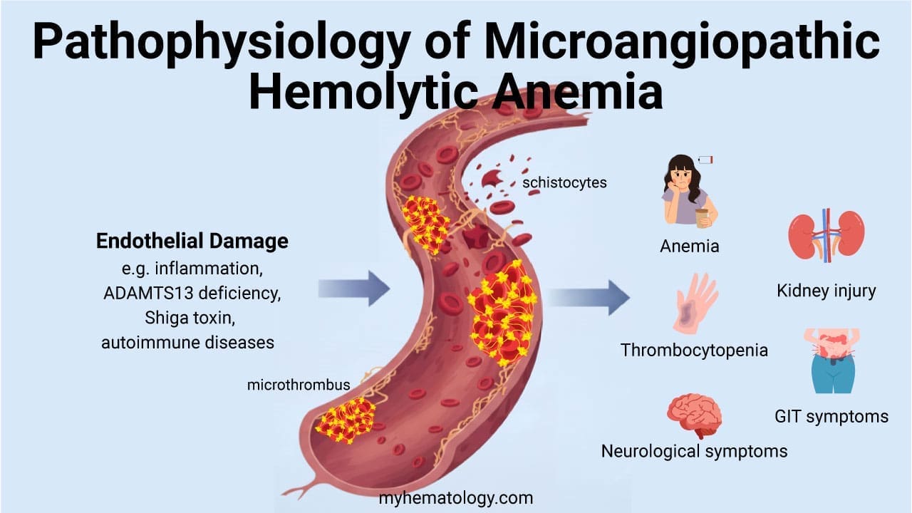 Microangiopathic Hemolytic Anemia (MAHA)