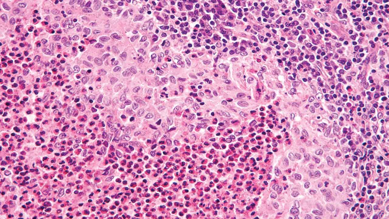 Langerhans Cell Histiocytosis (Histiocytosis X)